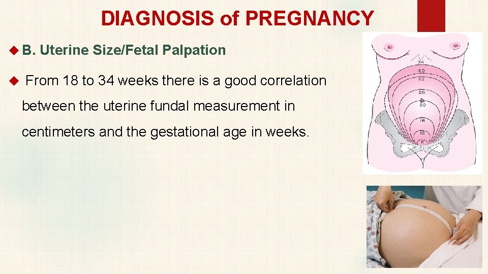 DIAGNOSIS of PREGNANCY B. Uterine Size/Fetal Palpation From 18 to 34 weeks there is
