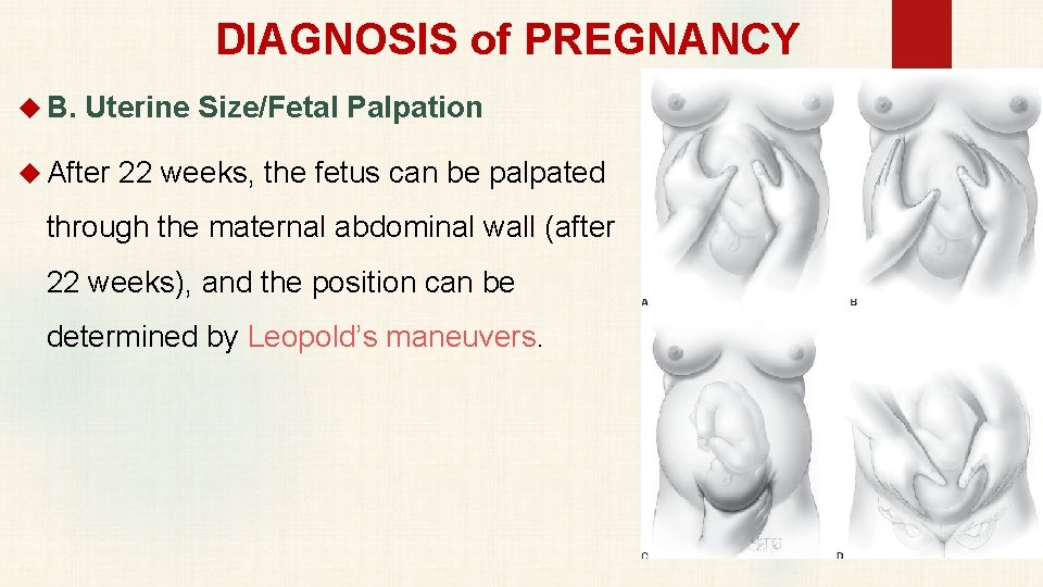 DIAGNOSIS of PREGNANCY B. Uterine Size/Fetal Palpation After 22 weeks, the fetus can be