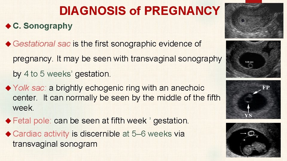 DIAGNOSIS of PREGNANCY C. Sonography Gestational sac is the first sonographic evidence of pregnancy.