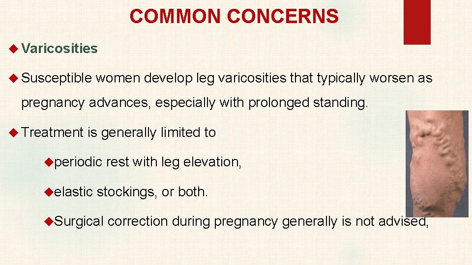 COMMON CONCERNS Varicosities Susceptible women develop leg varicosities that typically worsen as pregnancy advances,