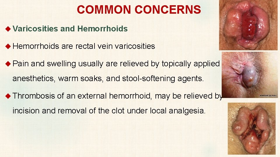 COMMON CONCERNS Varicosities and Hemorrhoids are rectal vein varicosities Pain and swelling usually are