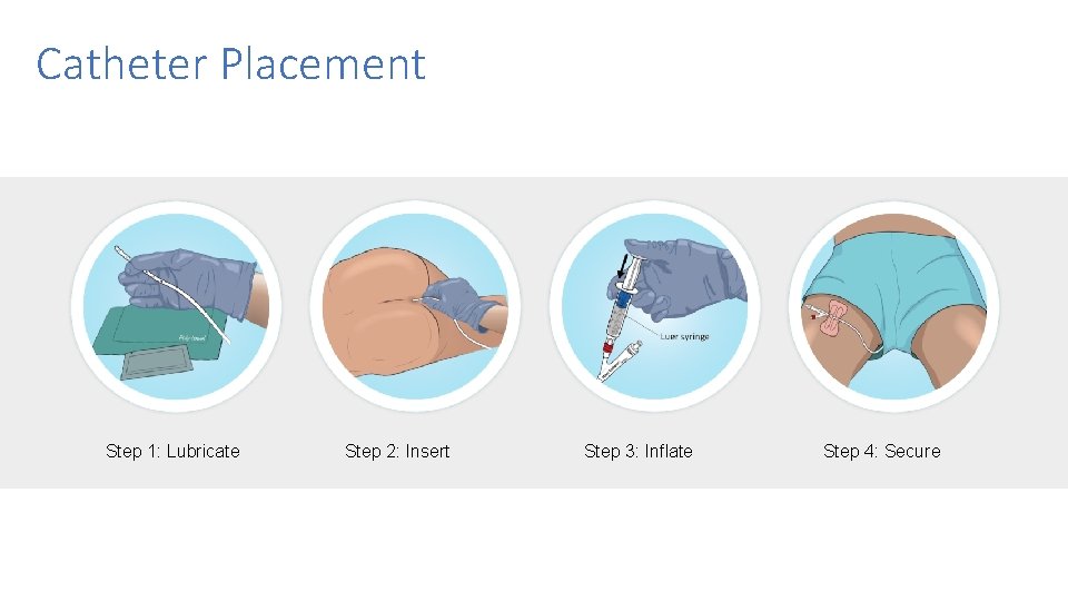 Catheter Placement Step 1: Lubricate Step 2: Insert Step 3: Inflate Step 4: Secure Catheter Placement Step 1: Lubricate Step 2: Insert Step 3: Inflate Step 4: Secure