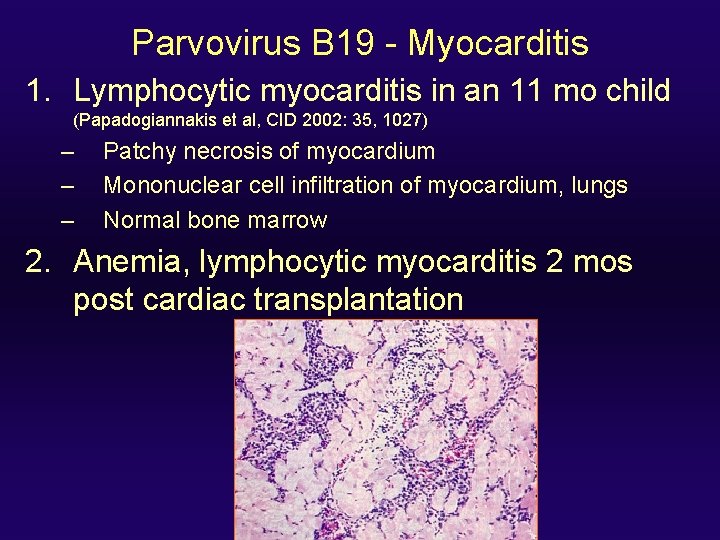Parvovirus B 19 - Myocarditis 1. Lymphocytic myocarditis in an 11 mo child (Papadogiannakis