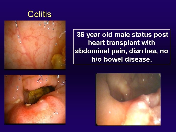 Colitis 36 year old male status post heart transplant with abdominal pain, diarrhea, no