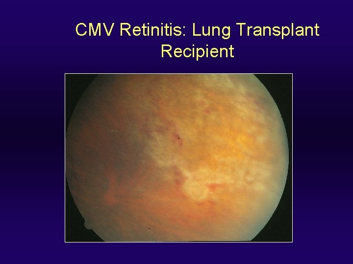 CMV Retinitis: Lung Transplant Recipient 