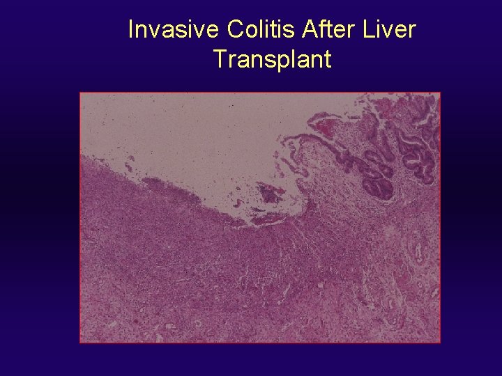 Invasive Colitis After Liver Transplant 