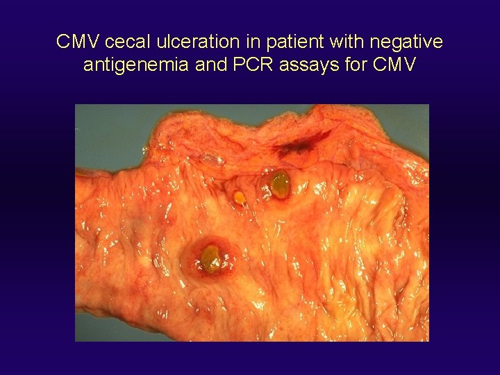 CMV cecal ulceration in patient with negative antigenemia and PCR assays for CMV 