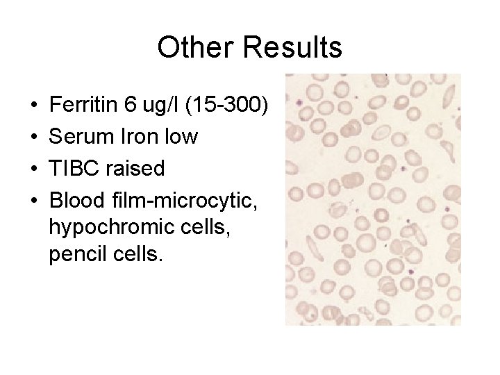 Other Results • • Ferritin 6 ug/l (15 -300) Serum Iron low TIBC raised