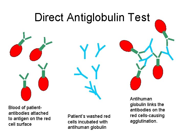 Direct Antiglobulin Test Blood of patientantibodies attached to antigen on the red cell surface