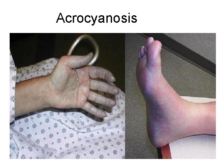 Acrocyanosis 