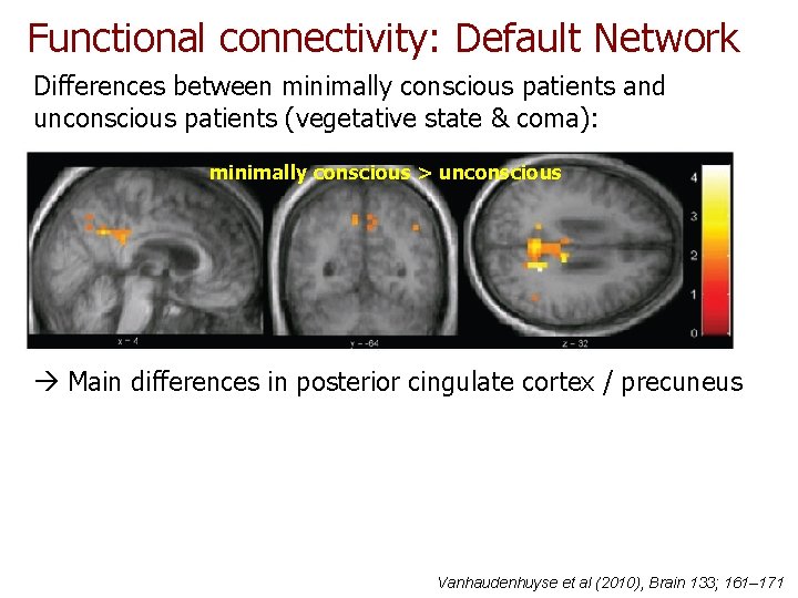 Functional connectivity: Default Network Differences between minimally conscious patients and unconscious patients (vegetative state Functional connectivity: Default Network Differences between minimally conscious patients and unconscious patients (vegetative state