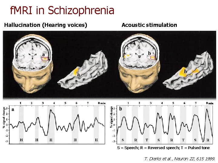 f. MRI in Schizophrenia Hallucination (Hearing voices) Acoustic stimulation S = Speech; R = f. MRI in Schizophrenia Hallucination (Hearing voices) Acoustic stimulation S = Speech; R =