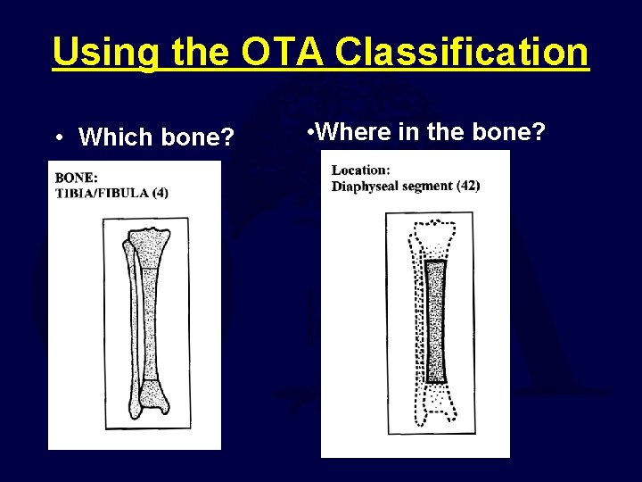 Using the OTA Classification • Which bone? • Where in the bone? 