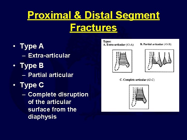 Proximal & Distal Segment Fractures • Type A – Extra-articular • Type B –
