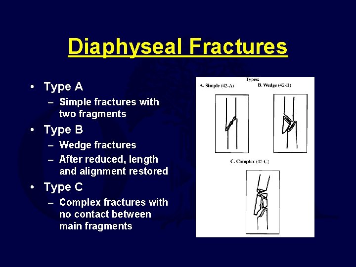 Diaphyseal Fractures • Type A – Simple fractures with two fragments • Type B