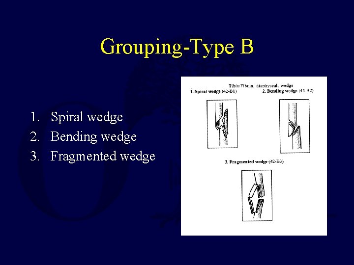 Grouping-Type B 1. Spiral wedge 2. Bending wedge 3. Fragmented wedge 
