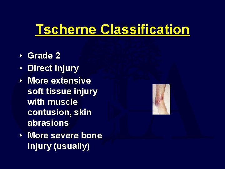 Tscherne Classification • Grade 2 • Direct injury • More extensive soft tissue injury