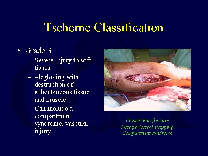 Tscherne Classification • Grade 3 – Severe injury to soft tisues – -degloving with