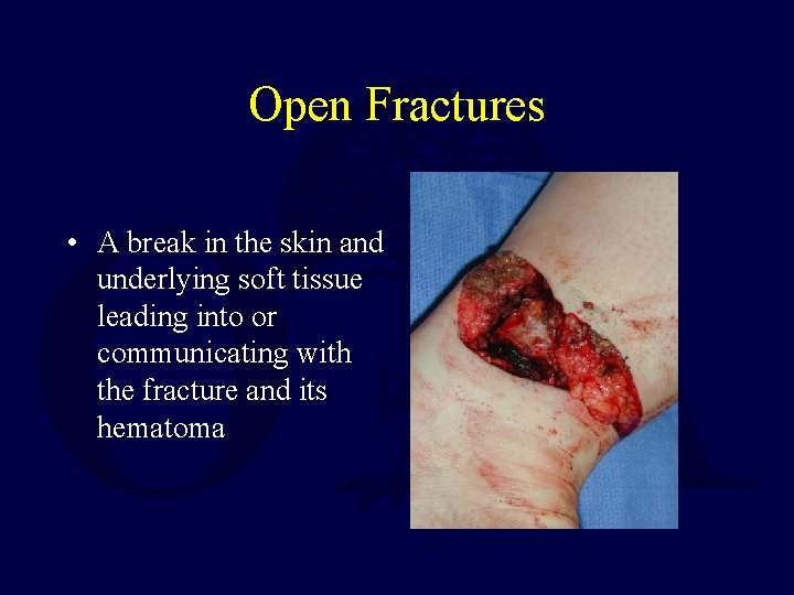 Open Fractures • A break in the skin and underlying soft tissue leading into