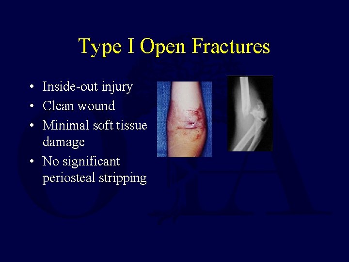 Type I Open Fractures • Inside-out injury • Clean wound • Minimal soft tissue