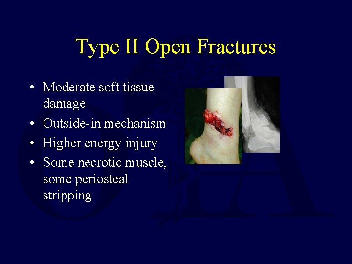 Type II Open Fractures • Moderate soft tissue damage • Outside-in mechanism • Higher