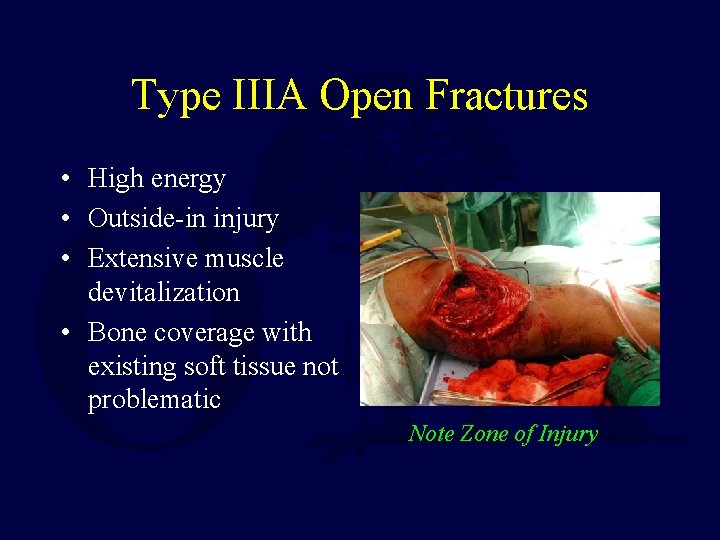 Type IIIA Open Fractures • High energy • Outside-in injury • Extensive muscle devitalization