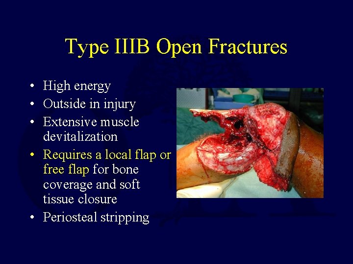 Type IIIB Open Fractures • High energy • Outside in injury • Extensive muscle