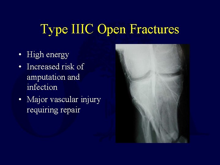 Type IIIC Open Fractures • High energy • Increased risk of amputation and infection