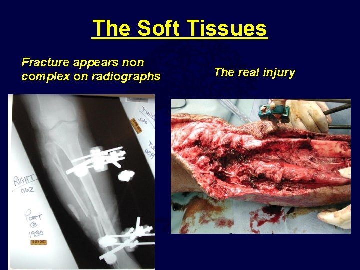 The Soft Tissues Fracture appears non complex on radiographs The real injury 