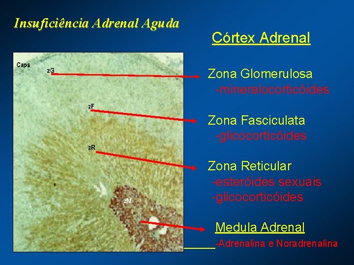 Insuficiência Adrenal Aguda Córtex Adrenal Zona Glomerulosa -mineralocorticóides Zona Fasciculata -glicocorticóides Zona Reticular -esteróides