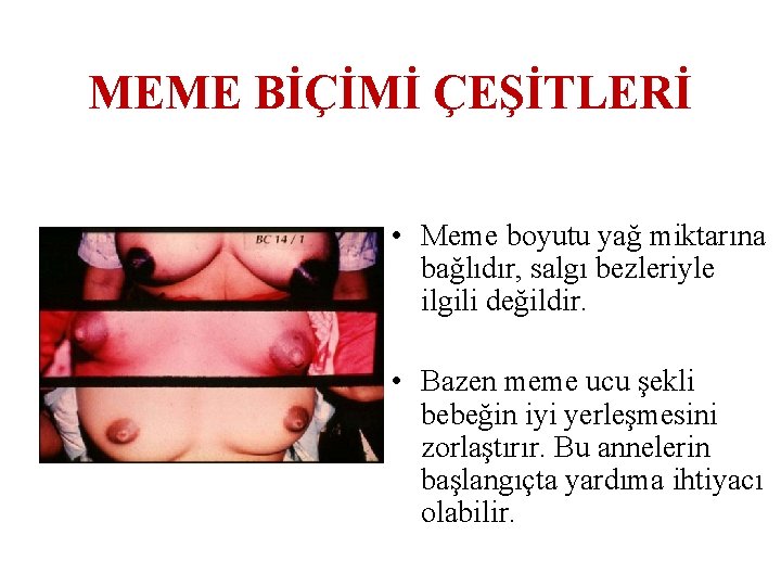 MEME BİÇİMİ ÇEŞİTLERİ • Meme boyutu yağ miktarına bağlıdır, salgı bezleriyle ilgili değildir. •