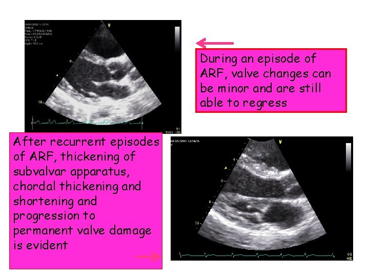 During an episode of ARF, valve changes can be minor and are still able