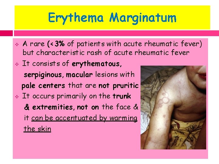Erythema Marginatum v v v A rare (<3% of patients with acute rheumatic fever)