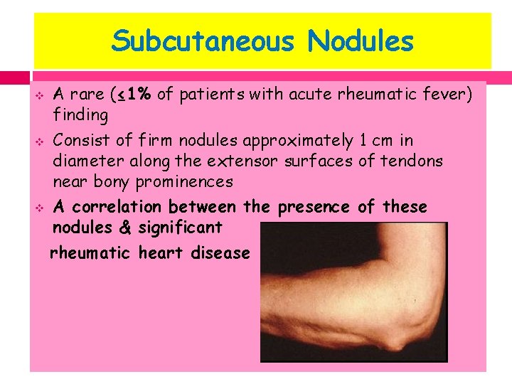 Subcutaneous Nodules v v v A rare (≤ 1% of patients with acute rheumatic