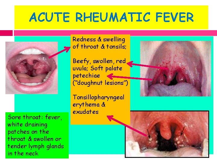 ACUTE RHEUMATIC FEVER Redness & swelling of throat & tonsils; Beefy, swollen, red uvula;