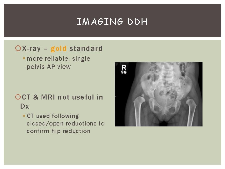 IMAGING DDH X-ray – gold standard § more reliable: single pelvis AP view CT