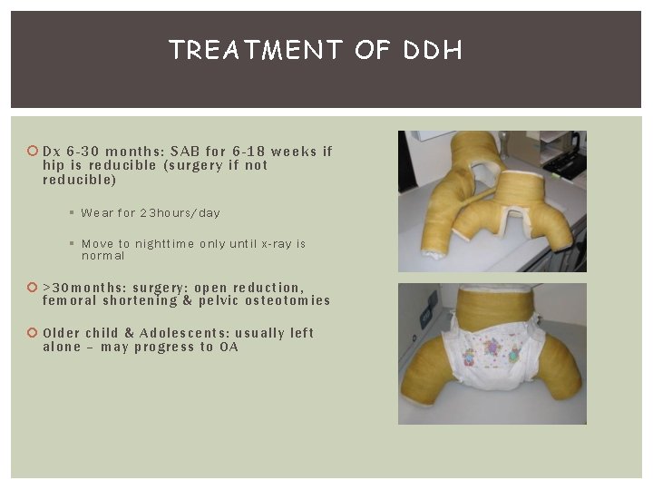 TREATMENT OF DDH Dx 6 -30 months: SAB for 6 -18 weeks if hip