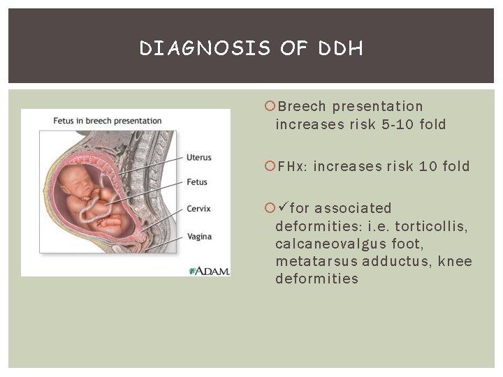 DIAGNOSIS OF DDH Breech presentation increases risk 5 -10 fold FHx: increases risk 10