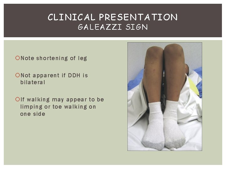 CLINICAL PRESENTATION GALEAZZI SIGN Note shortening of leg Not apparent if DDH is bilateral