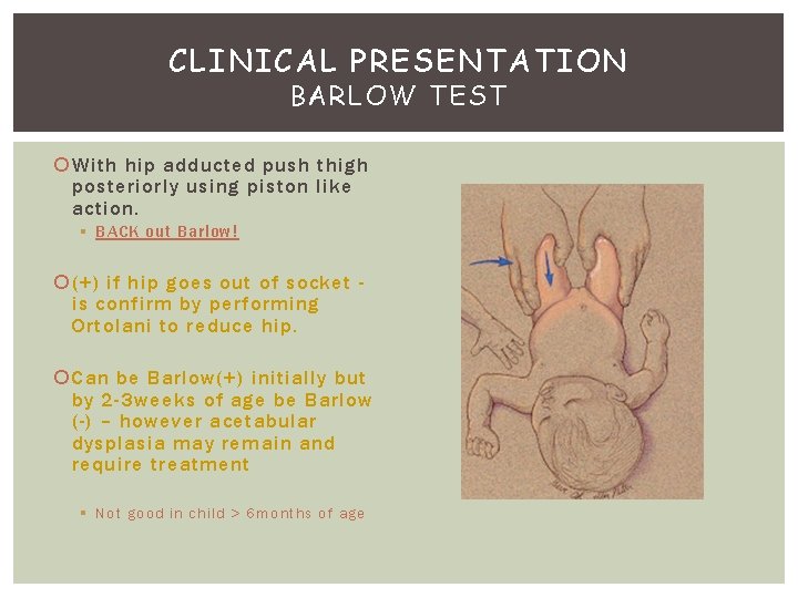 CLINICAL PRESENTATION BARLOW TEST With hip adducted push thigh posteriorly using piston like action.