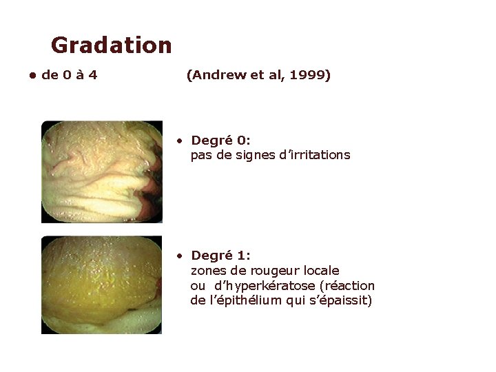 Gradation • de 0 à 4 (Andrew et al, 1999) • Degré 0: pas