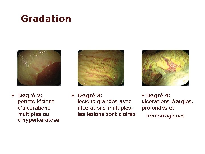 Gradation • Degré 2: petites lésions d’ulcerations multiples ou d’hyperkératose • Degré 3: lesions