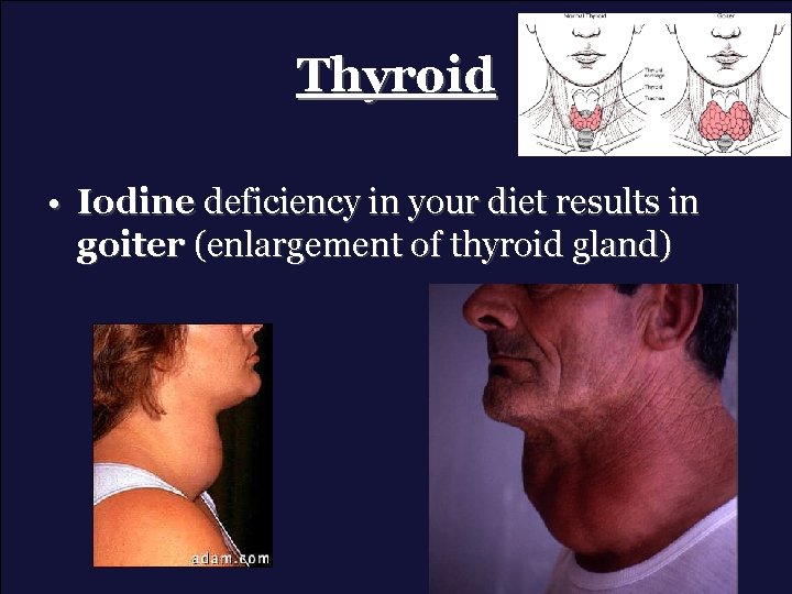 Thyroid • Iodine deficiency in your diet results in goiter (enlargement of thyroid gland)