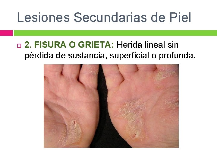 Lesiones Secundarias de Piel 2. FISURA O GRIETA: Herida lineal sin pérdida de sustancia,