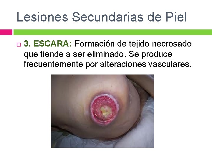 Lesiones Secundarias de Piel 3. ESCARA: Formación de tejido necrosado que tiende a ser