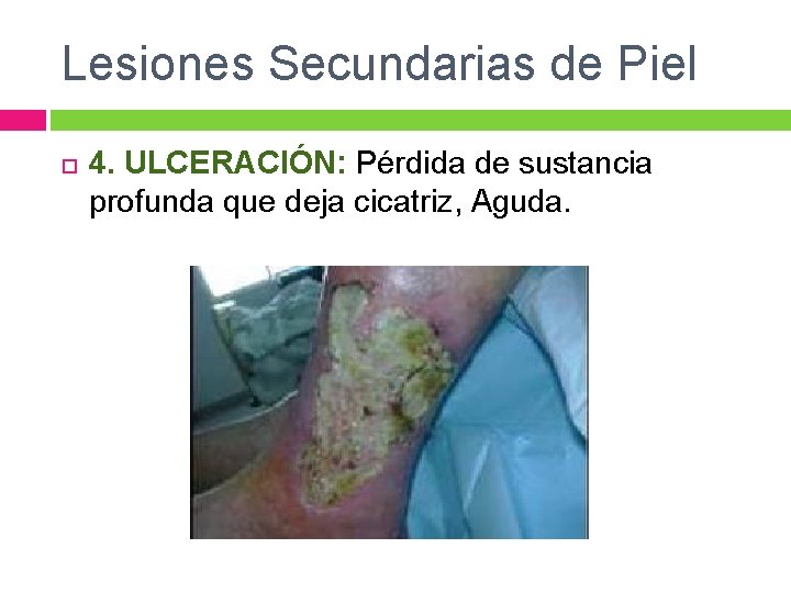 Lesiones Secundarias de Piel 4. ULCERACIÓN: Pérdida de sustancia profunda que deja cicatriz, Aguda.