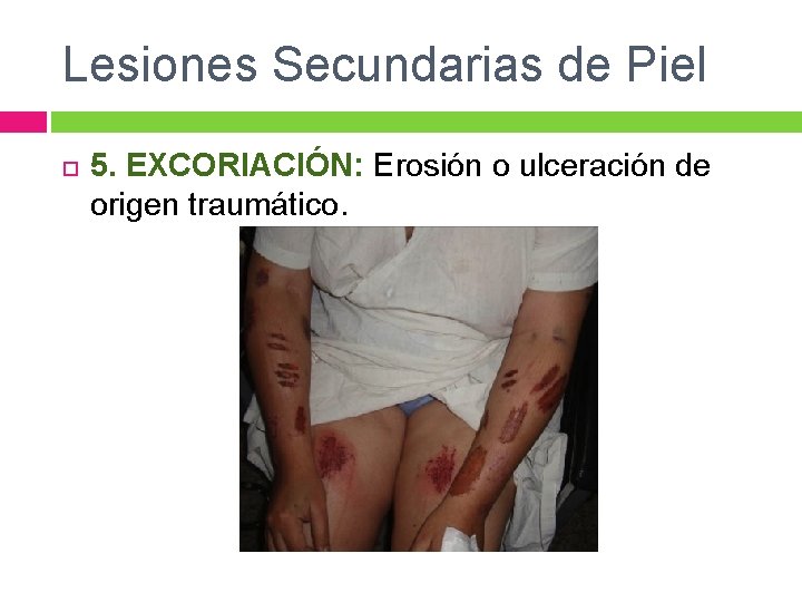 Lesiones Secundarias de Piel 5. EXCORIACIÓN: Erosión o ulceración de origen traumático. 