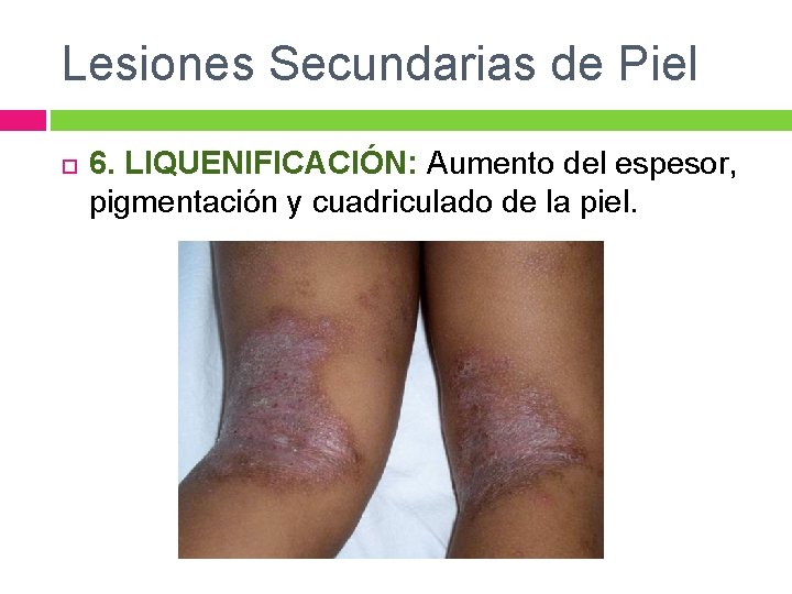 Lesiones Secundarias de Piel 6. LIQUENIFICACIÓN: Aumento del espesor, pigmentación y cuadriculado de la