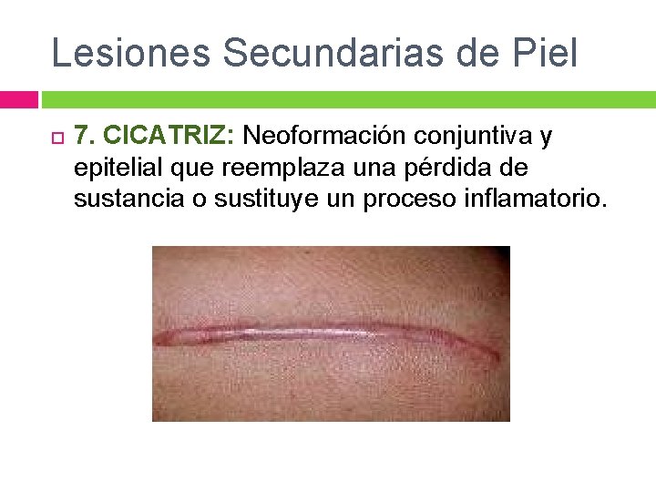 Lesiones Secundarias de Piel 7. CICATRIZ: Neoformación conjuntiva y epitelial que reemplaza una pérdida