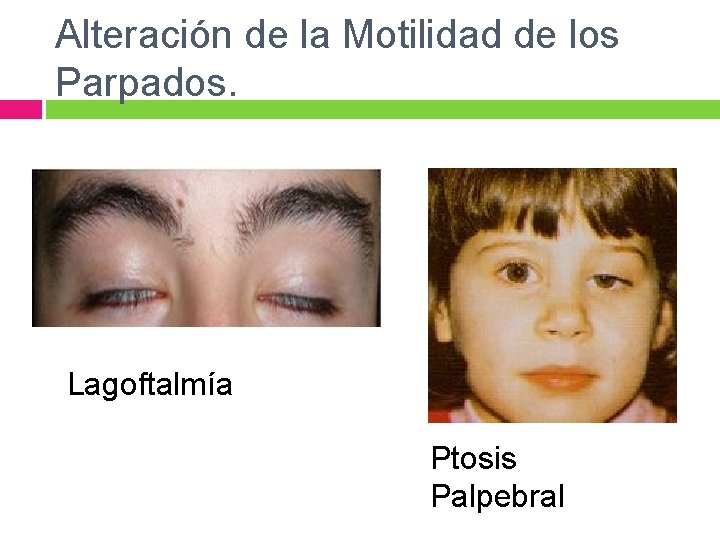 Alteración de la Motilidad de los Parpados. Lagoftalmía Ptosis Palpebral 